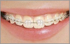 clear braces