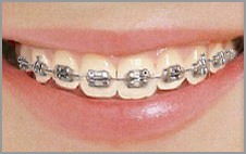 metal braces